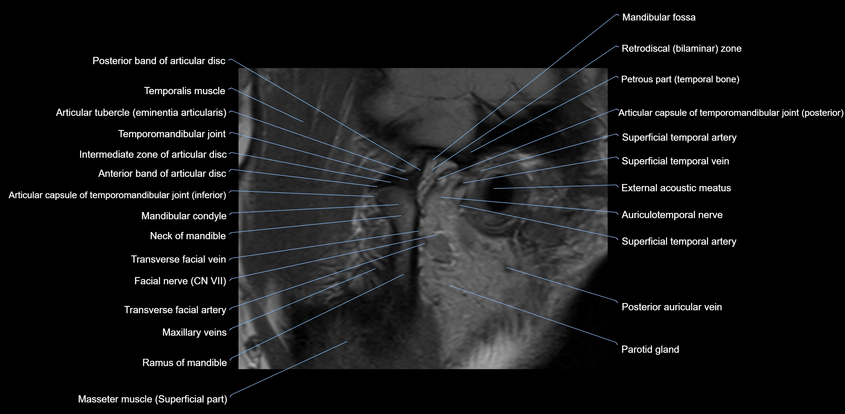 MRI TMJ sagittal open  mouth cross sectional 3T anatomy -img-00001-00006.webp